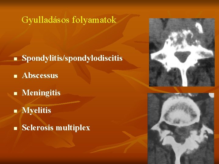 Gyulladásos folyamatok n Spondylitis/spondylodiscitis n Abscessus n Meningitis n Myelitis n Sclerosis multiplex 