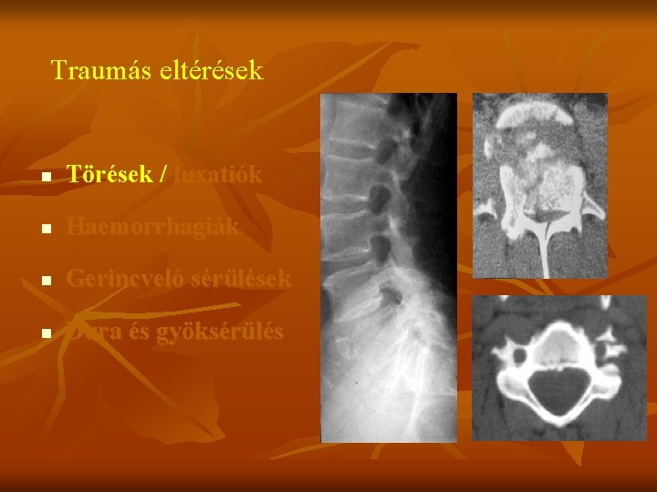 Traumás eltérések n Törések / luxatiók n Haemorrhagiák n Gerincvelő sérülések n Dura és