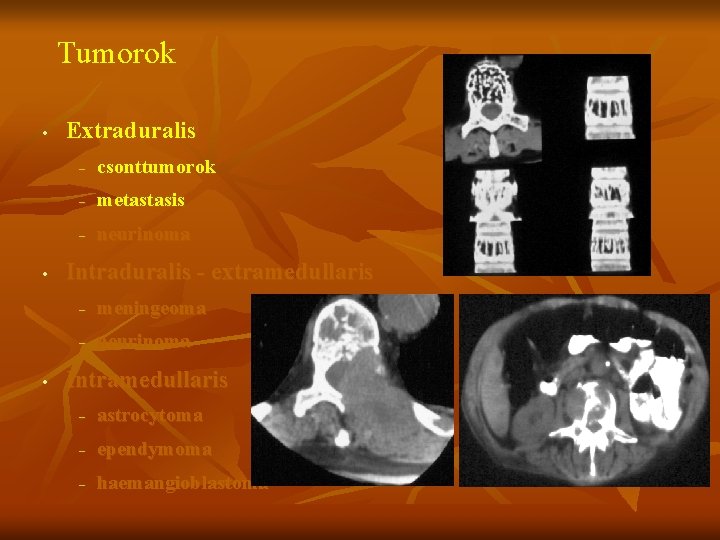 Tumorok • • • Extraduralis – csonttumorok – metastasis – neurinoma Intraduralis - extramedullaris