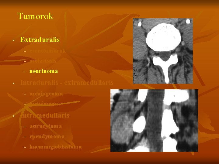 Tumorok • • • Extraduralis – csonttumorok – metastasis – neurinoma Intraduralis - extramedullaris