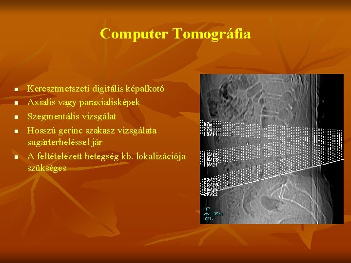 Computer Tomográfia n n n Keresztmetszeti digitális képalkotó Axialis vagy paraxialisképek Szegmentális vizsgálat Hosszú