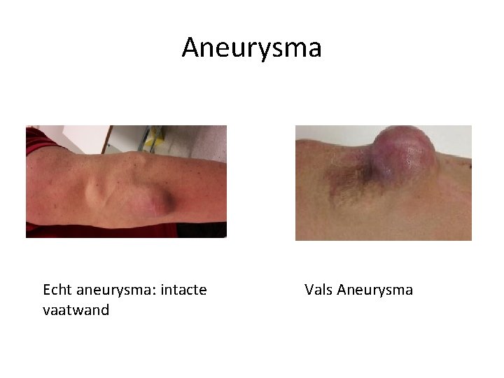 Aneurysma Echt aneurysma: intacte vaatwand Vals Aneurysma 
