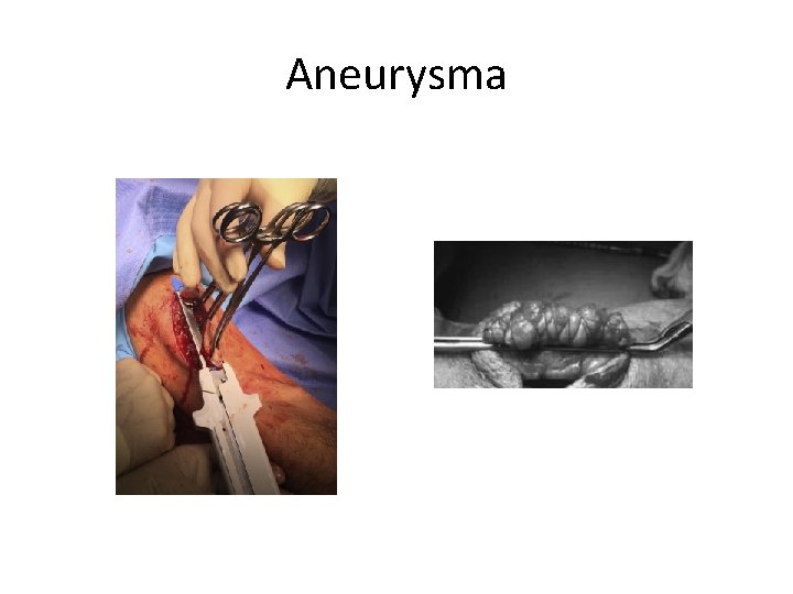 Aneurysma 