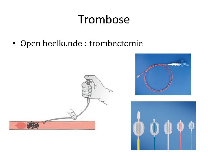 Trombose • Open heelkunde : trombectomie 
