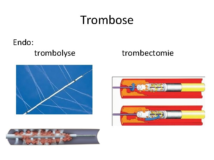 Trombose Endo: trombolyse trombectomie 