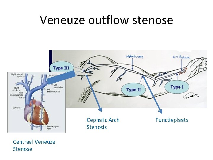 Veneuze outflow stenose Cephalic Arch Stenosis Centraal Veneuze Stenose Punctieplaats 