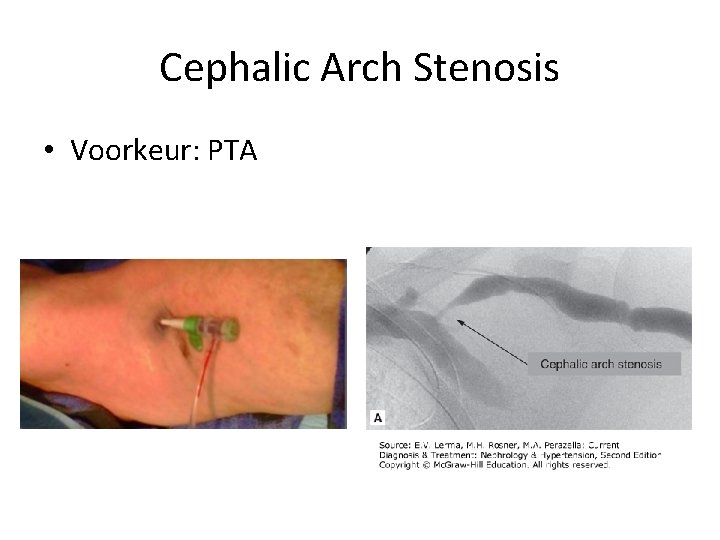 Cephalic Arch Stenosis • Voorkeur: PTA 