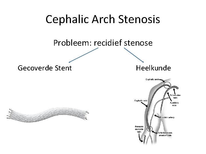 Cephalic Arch Stenosis Probleem: recidief stenose Gecoverde Stent Heelkunde 