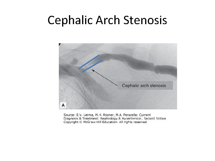 Cephalic Arch Stenosis 
