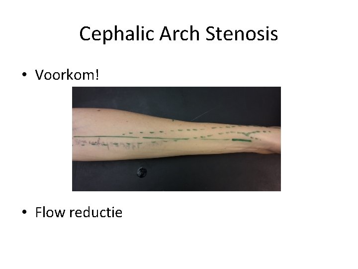 Cephalic Arch Stenosis • Voorkom! • Flow reductie 