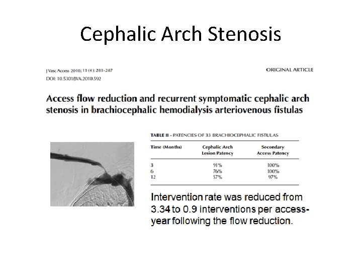 Cephalic Arch Stenosis 