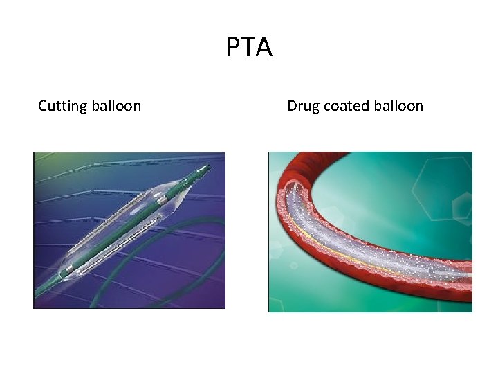 PTA Cutting balloon Drug coated balloon 