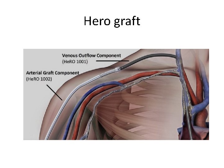 Hero graft 