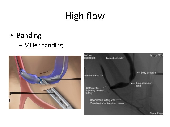 High flow • Banding – Miller banding 