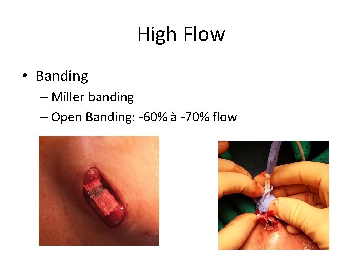 High Flow • Banding – Miller banding – Open Banding: -60% à -70% flow