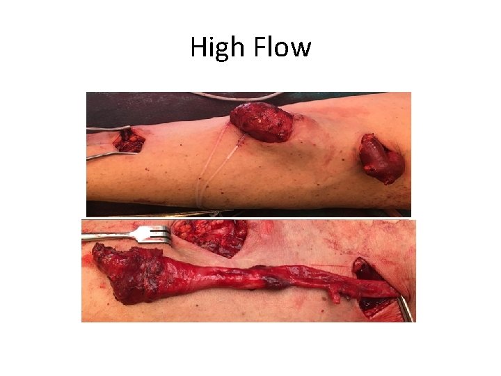 High Flow 