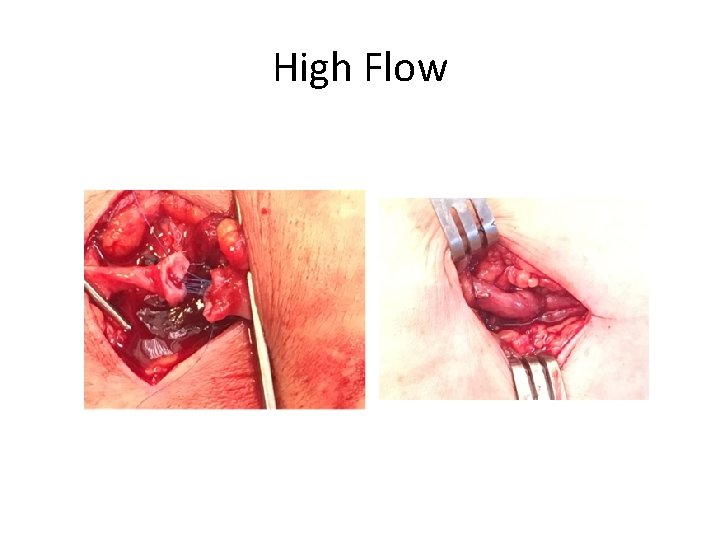 High Flow 