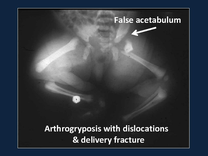 False acetabulum Arthrogryposis with dislocations & delivery fracture 