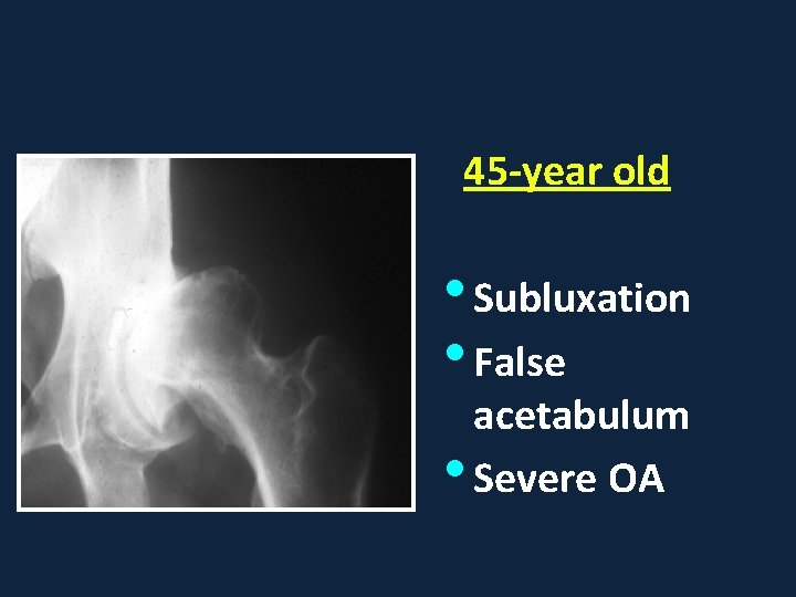 45 -year old • Subluxation • False acetabulum • Severe OA 