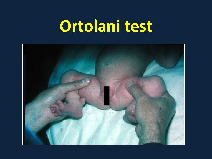 Ortolani test 
