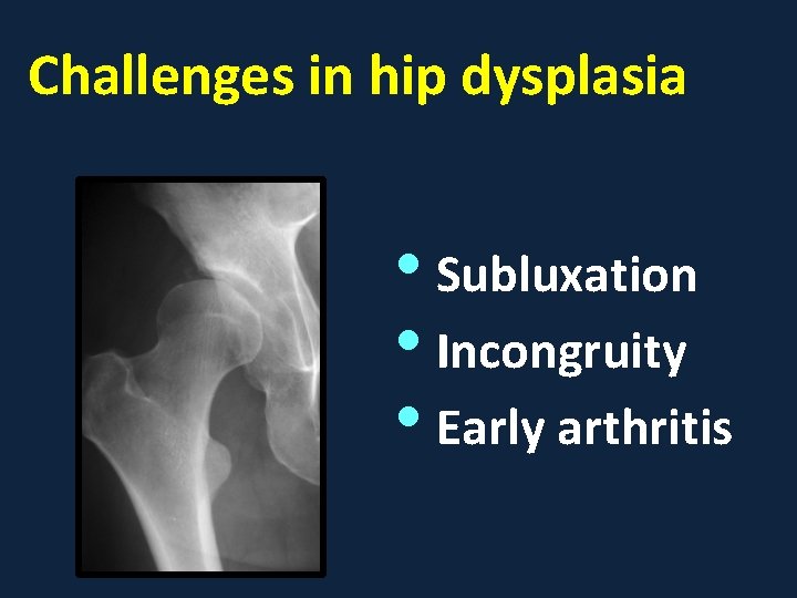 Challenges in hip dysplasia • Subluxation • Incongruity • Early arthritis 