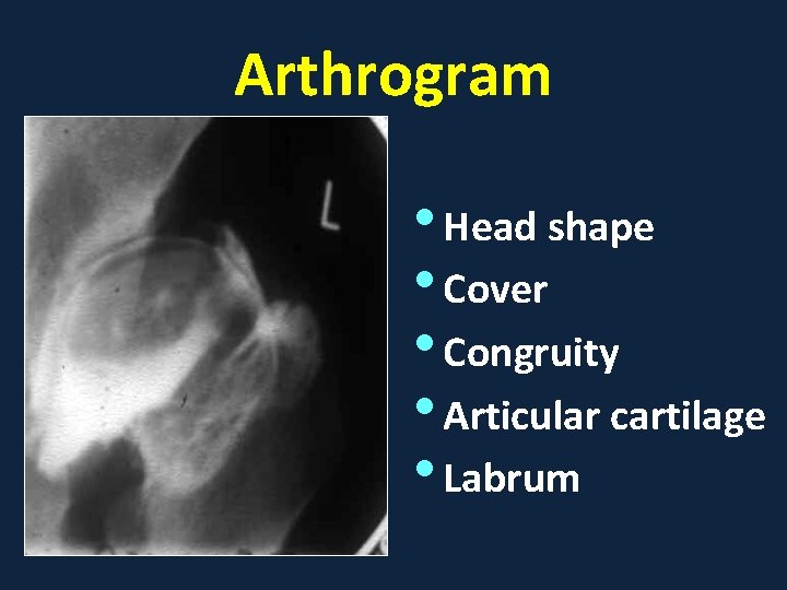 Arthrogram • Head shape • Cover • Congruity • Articular cartilage • Labrum 