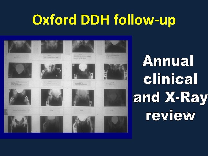 Oxford DDH follow-up 