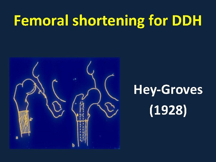 Femoral shortening for DDH Hey-Groves (1928) 