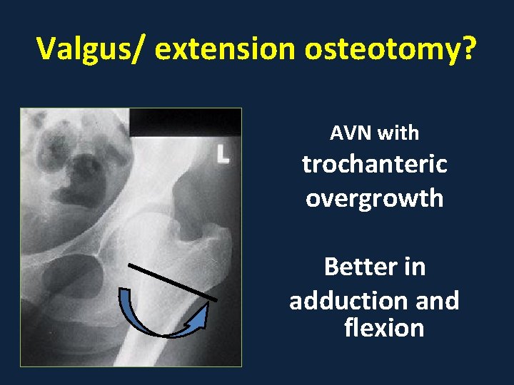 Valgus/ extension osteotomy? AVN with trochanteric overgrowth Better in adduction and flexion 