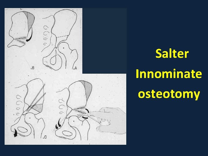 Salter Innominate osteotomy 