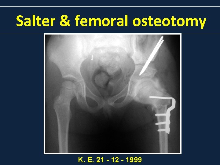 Salter & femoral osteotomy K. E. 21 - 12 - 1999 