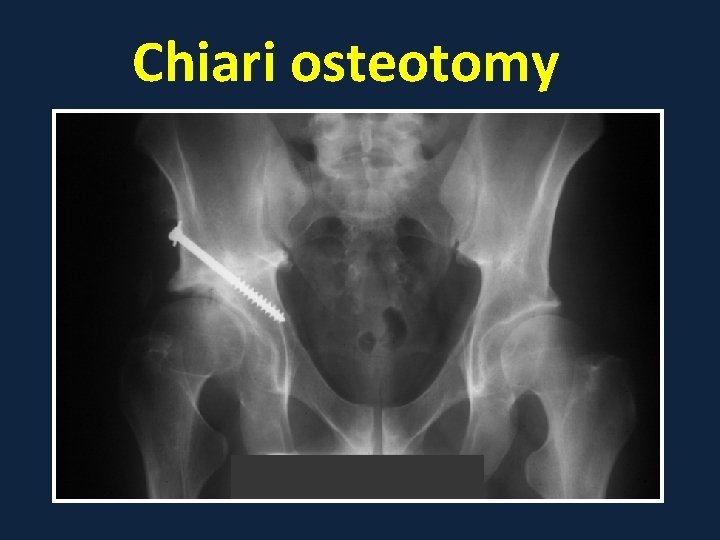 Chiari osteotomy 
