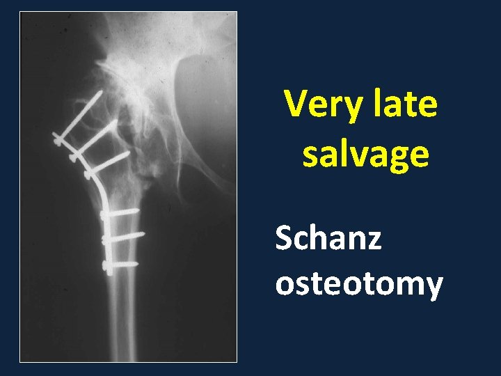 Very late salvage Schanz osteotomy 