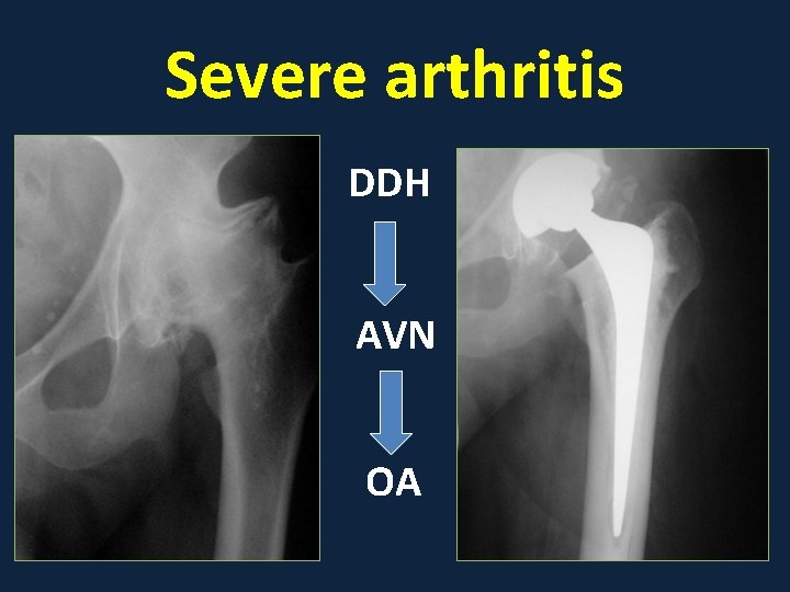 Severe arthritis DDH AVN OA 