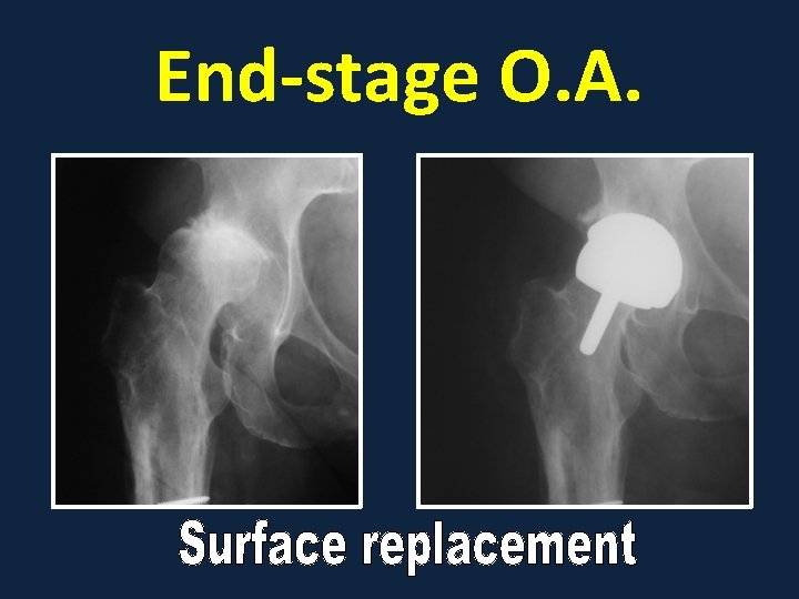 End-stage O. A. 