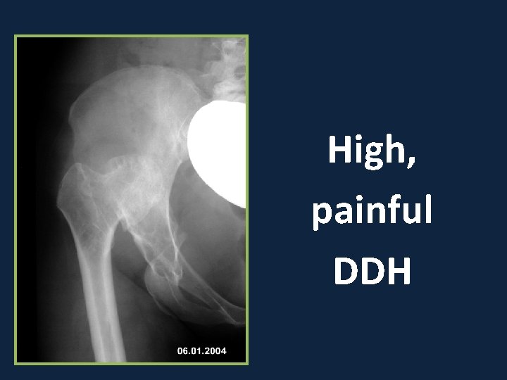 High, painful DDH 