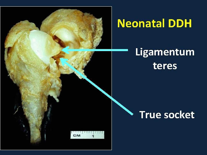 Neonatal DDH Ligamentum teres True socket 