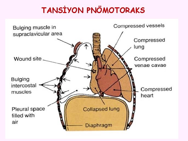 TANSİYON PNÖMOTORAKS 