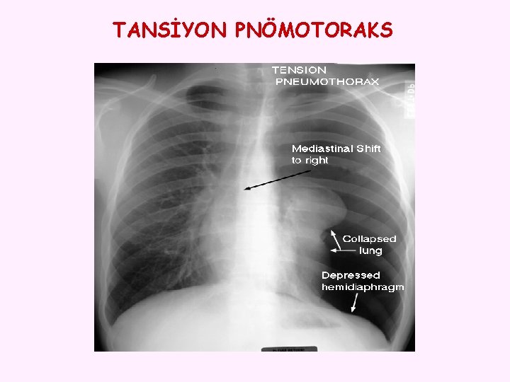 TANSİYON PNÖMOTORAKS 