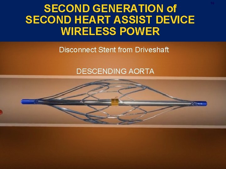 SECOND GENERATION of SECOND HEART ASSIST DEVICE WIRELESS POWER Disconnect Stent from Driveshaft DESCENDING SECOND GENERATION of SECOND HEART ASSIST DEVICE WIRELESS POWER Disconnect Stent from Driveshaft DESCENDING