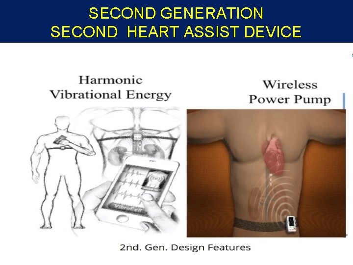 SECOND GENERATION SECOND HEART ASSIST DEVICE SECOND GENERATION SECOND HEART ASSIST DEVICE