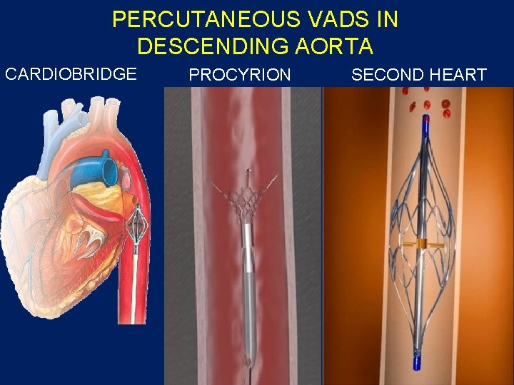PERCUTANEOUS VADS IN DESCENDING AORTA CARDIOBRIDGE PROCYRION SECOND HEART PERCUTANEOUS VADS IN DESCENDING AORTA CARDIOBRIDGE PROCYRION SECOND HEART