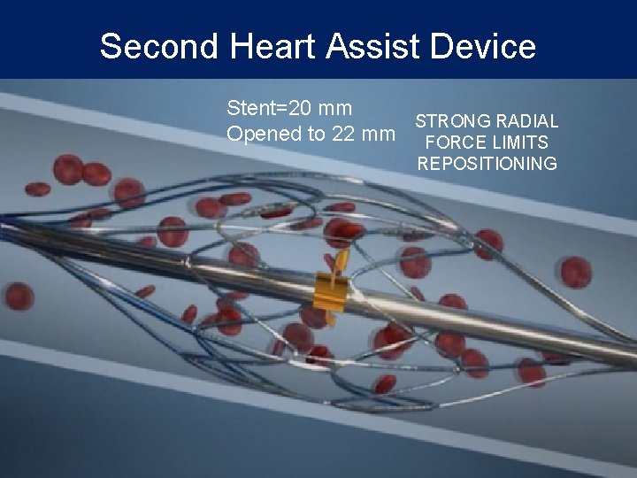 Second Heart Assist Device Stent=20 mm STRONG RADIAL Opened to 22 mm FORCE LIMITS Second Heart Assist Device Stent=20 mm STRONG RADIAL Opened to 22 mm FORCE LIMITS