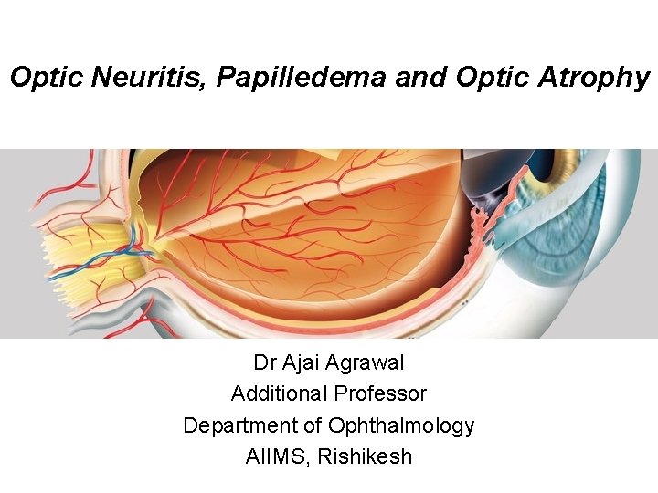 Optic Neuritis, Papilledema and Optic Atrophy Dr Ajai Agrawal Additional Professor Department of Ophthalmology