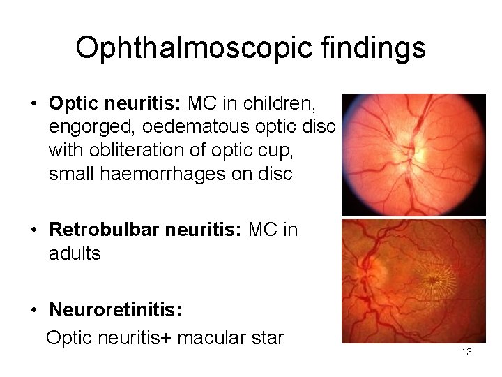 Ophthalmoscopic findings • Optic neuritis: MC in children, engorged, oedematous optic disc with obliteration