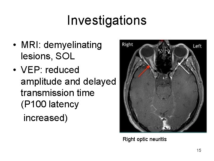 Investigations • MRI: demyelinating lesions, SOL • VEP: reduced amplitude and delayed transmission time