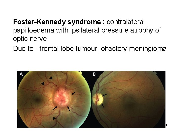 Foster-Kennedy syndrome : contralateral papilloedema with ipsilateral pressure atrophy of optic nerve Due to