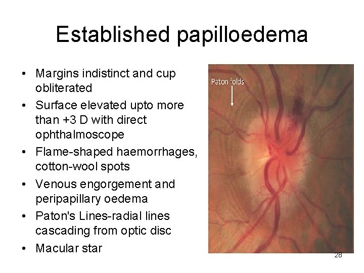 Established papilloedema • Margins indistinct and cup obliterated • Surface elevated upto more than