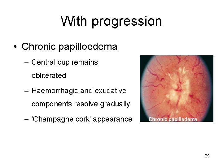 With progression • Chronic papilloedema – Central cup remains obliterated – Haemorrhagic and exudative