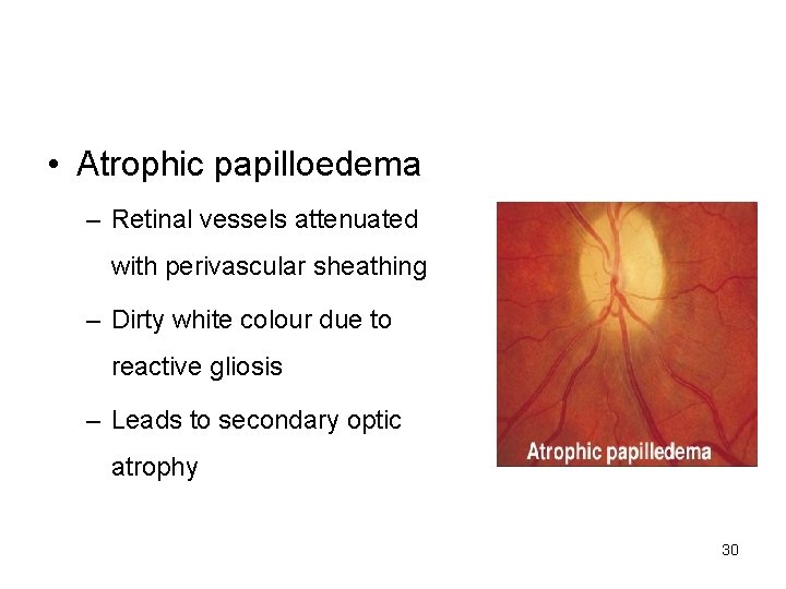  • Atrophic papilloedema – Retinal vessels attenuated with perivascular sheathing – Dirty white